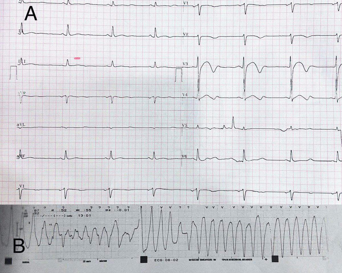 drsaavedra's tweet photo. A 30yo male with known LQTS on Nadolol travels to high altitude(3399mts).On his 4th day complains of lightheadedness and syncope of few seconds. Short bursts of this(B) are registered. Never underestimate the effects of high altitude on the cardiovascular system. https://t.co/OPt1lHVF21