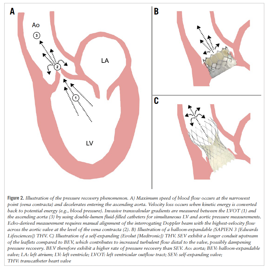 EuroInterventio's tweet photo. How should transvalvular gradients be assessed after TAVI?
This propensity score-matched study found that invasively measured gradients, but not echocardiography-derived gradients, independently predicted mortality, highlighting the potential prognostic value of invasive haemodynamic assessment after valve implantation. `
🔗https://t.co/Nb5dAvZLpB

 #TAVI #StructuralHeart #Hemodynamics  #EIJBestOf

@RikAdrMD @verhemel  @Rjnuis @drnvanmieghem