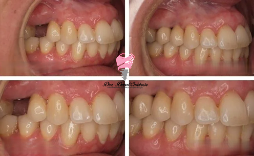 DraDuvalC's tweet photo. ¡Cambiando vidas creando #sonrisas! #cordales #mueladeljuicio #DraDuvalCalderon #odontología #dentistry #smile #sonrisa #sonrisas #implantes #dentalimplant #DentalsImplants #endodoncia #periodoncia #ortodoncia #dientes #dentaduras #PrótesisDental #OdontologíaEspecializada https://t.co/dRmZVC0ST4