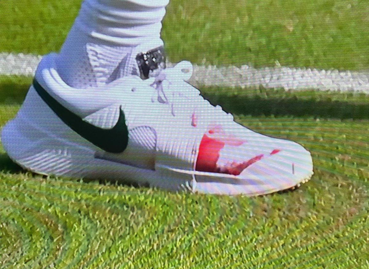 CharlieJoe4's tweet photo. @BenRothenberg Sinner is bleeding and has increased. this is few min ago.

#Wimbledon #JannikSinner https://t.co/FpP2pCgDYd