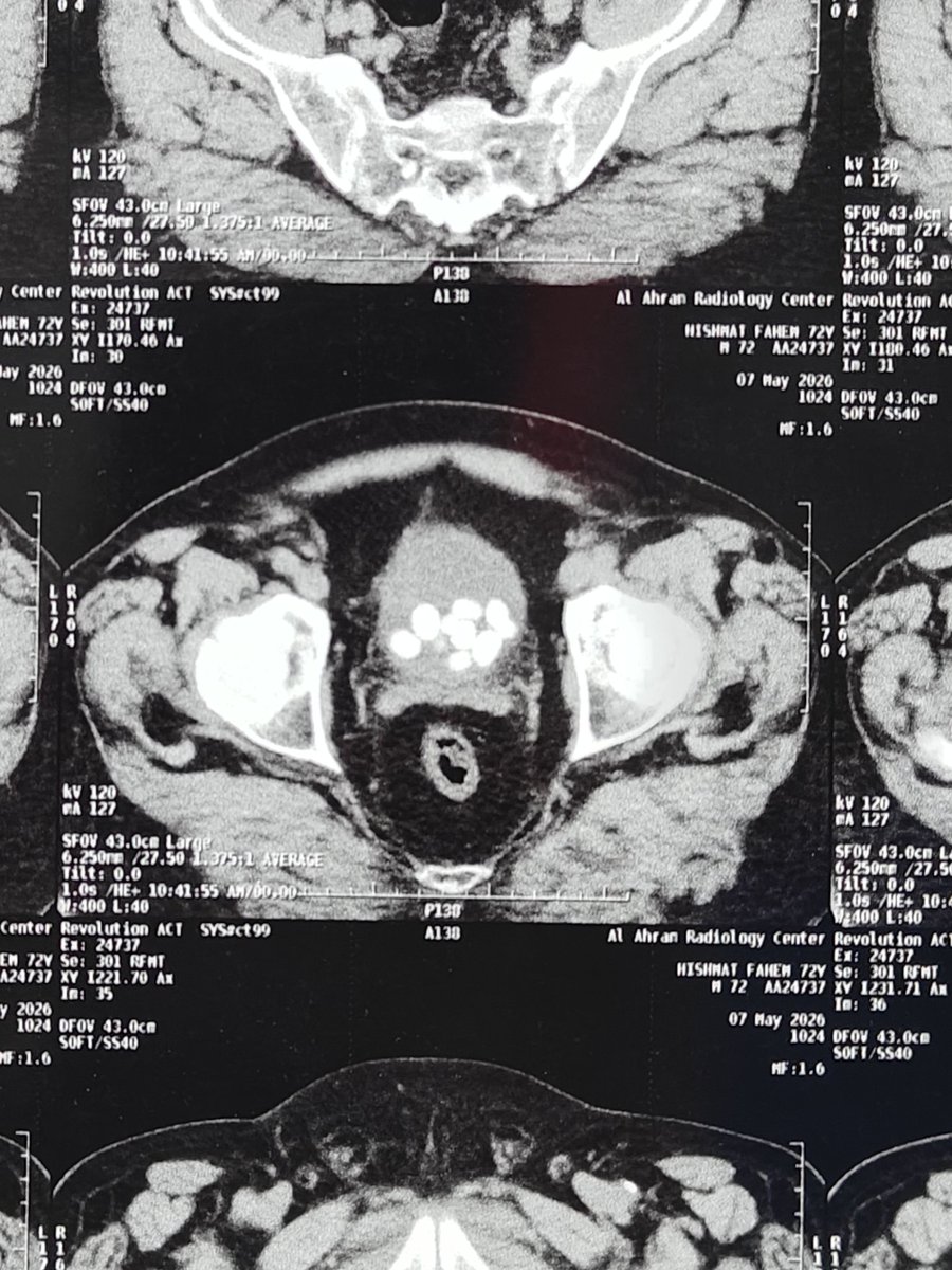 Eslam_wareth's tweet photo. Challenging case of the day 
Multiple enumerable stones in the bladder about 15 stone 

Open 
Or 
Endoscopic 
?
🤔 https://t.co/KjmnOhB8Tk