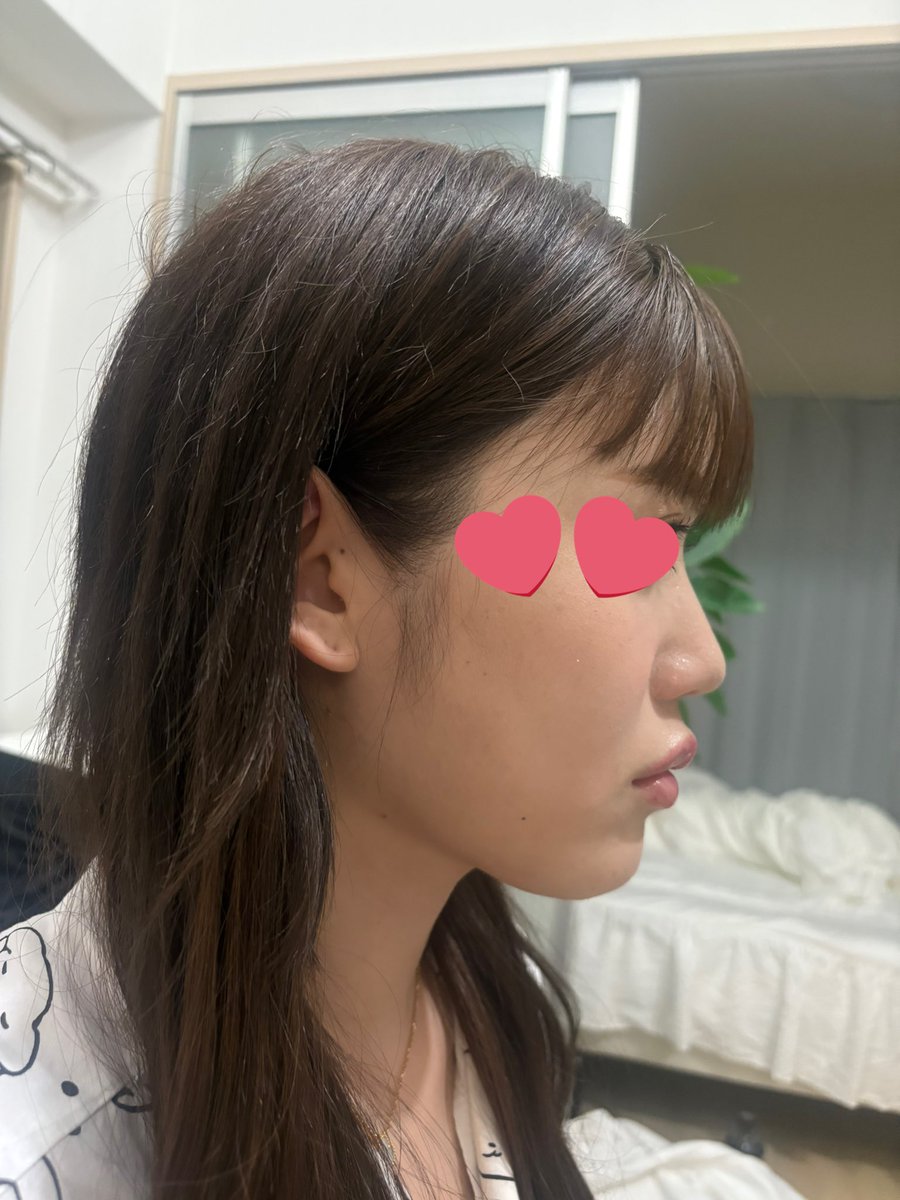 80_901's tweet photo. ほぼ同じ角度の写真探したけど
after⇄before

一応ナチュラル思考。

#渡韓整形 https://t.co/hl9XvfZAz2