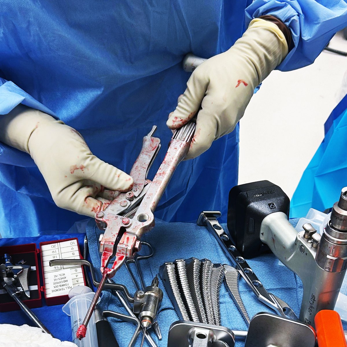 ShuklaMedical's tweet photo. This is why you want Shukla in the OR from the start: After an unsuccessful first try, this surgeon returned a week later to remove stubborn titanium screws. With the power of the SHUKLA Screw System and Multi-Vise, a challenging #extraction became another #ShuklaSuccessStory. https://t.co/HHimjrnOTj