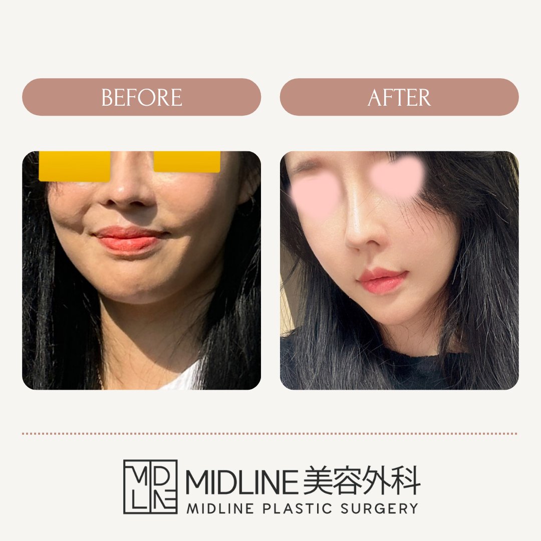 MIDLINEps_jp's tweet photo. 術法 
#マルチ内視鏡額リフト #目の下脂肪移植

感想  
フェイスラインがすっきりして嬉しいです。
目の下の脂肪移植後は疲れて見られることが減り、顔全体が明るく見えるようになり、大きく変わりすぎず自然な仕上がりで大満足です！

📩公式LINE
 https://t.co/RMlqlblFXr https://t.co/Zu6uHeXidO