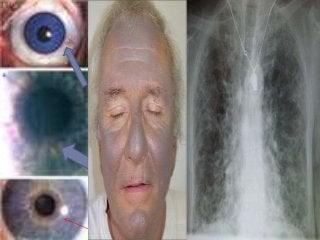 Hendrina32's tweet photo. Hittestress en Amiodarone betekent: bedlerigheid, decubitus en sepsis.
@nvdietist @HvA_Ergo @SepsisAlliance @VenVN @Apothekernieuws @FlorenceZorg @LHVhuisartsen @Hartkliniek @nrc https://t.co/jRk6H3zlLr