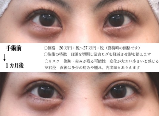 drmatsui's tweet photo. 内側の白目を大きくしたい場合、有効な手段となりうる目頭切開。
隠れている白目があるなら拡大が可能。
そしてどこまで大きくするかも調整できます。
ただ隠れていない場合は変化させられない。
ちょっとしか隠れていない場合も変化に乏しくなってしまいます。
＃目頭切開 https://t.co/t35iUjwix1