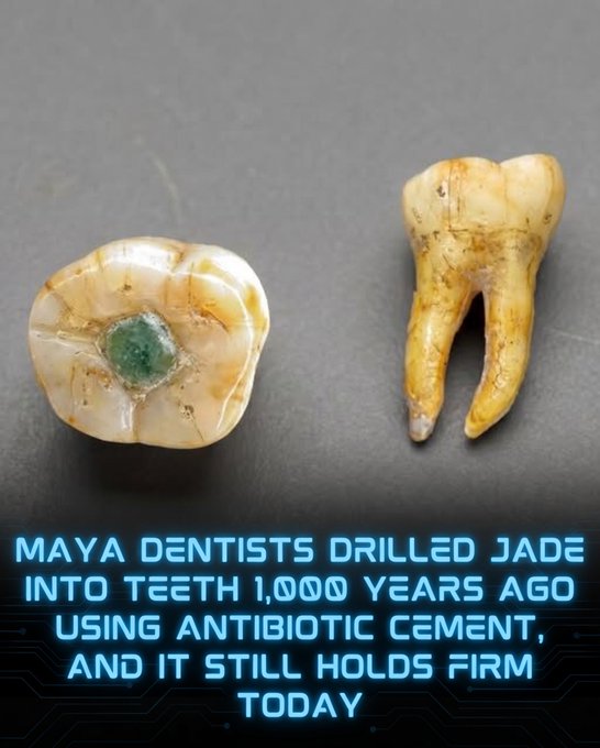 Rainmaker1973's tweet photo. Ancient Maya dentistry protected teeth from decay with advanced adhesives.

Long before modern dentistry, the ancient Maya of the Classic period (A.D. 250–900) were masters of dental modification. Skilled artisans used copper tubes and quartz abrasives to precisely drill cavities into the front teeth — carefully avoiding the pulp and sensitive nerves — before inlaying precious stones such as jade, pyrite, or turquoise. These gemstone inlays served as powerful symbols of social status, beauty, and religious significance, often representing the “breath of life.” Remarkably, the practice was widespread across social classes and was even performed on children as young as seven years old.

What makes this ancient technique truly remarkable is the sophisticated adhesive used to secure the stones. Recent chemical analysis reveals that Maya dentists crafted a durable, plant-based cement from resins (including pine), bone meal, and other organic compounds. This glue not only held the inlays firmly in place for over a thousand years but also possessed potent antibacterial and anti-inflammatory properties.

Far from causing harm, these dental enhancements likely acted as protective barriers against tooth decay and infection. By combining aesthetic luxury with practical medicinal science, the Maya created one of the earliest known examples of therapeutic dentistry.

[Hernández-Bolio, G. I., et al. (2022). "Organic compositional analysis of ancient Maya tooth sealants and fillings." Journal of Archaeological Science: Reports, 44, 103480. DOI: 10.1016/j.jasrep.2022.103480]