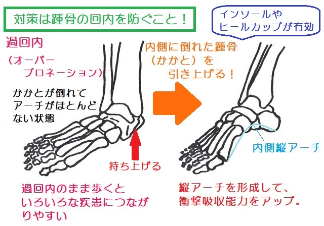 hondaseikotsu's tweet photo. 🦶 かかとが内側に倒れていませんか？

「回内足（オーバープロネーション）」という言葉を聞いたことはありますか？

踵骨（かかと）が内側に傾き、足のアーチがつぶれた状態のことです。

─────────────────
🔍 なぜ起こる？
─────────────────

・足の筋力低下（特に後脛骨筋・母趾外転筋）
・体重増加や長時間の立ち仕事
・クッション性の低い靴の使用
・もともとの骨格・関節のゆるみ

こうした要因が重なると、踵骨（かかと）が内側に倒れやすくなります。

─────────────────
⚠️ 放置するとどうなる？
─────────────────

回内足のまま歩き続けると、足だけでなく全身にも影響が出やすいといわれています。

・足底腱膜炎（足裏の痛み）
・外反母趾・扁平足の悪化
・膝の内側への負担増加
・腰痛・骨盤のゆがみ

アーチが機能しないと、衝撃吸収がうまくできなくなってしまうのです。

─────────────────
✅ 予防・対策のポイント
─────────────────

【① インソール・ヒールカップを活用する】
内側に倒れた踵骨を外側から支えることで、アーチを正しい位置に誘導できます。

【② 足の内側の筋肉を鍛える】
タオルギャザーやショートフットエクササイズで、アーチを支える筋肉を強化しましょう。

【③ 靴選びを見直す】
かかとのホールド感がしっかりした靴を選ぶことが基本です。

【④後脛骨筋の機能維持】
足首を内側に（親指を身体の中心に）力を入れるようにバンドなどでエクササイズ

─────────────────

「かかとが疲れやすい」「靴の内側だけすり減る」という方は、回内足のサインかもしれません🔔

気になる症状があれば、お気軽にご相談ください😊