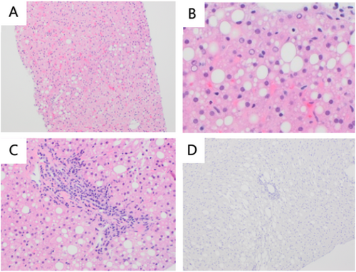 JPGNReports's tweet photo. 🚨 #Wilsondisease without the “classic” clues?!

Palan et al: whole-exome sequencing cracked a tricky case
no KF rings, borderline copper, AIH/MASLD mimic - Dx unlocked 🔬➡️ 

#PedsGI #Hepatology #LiverTwitter #LiverPath

🔗 https://t.co/iWhmBGKUAp https://t.co/aw7vRhYZDV