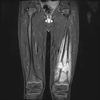 CleClinicMD's tweet photo. Researchers have discovered a gene that predisposes patients to osteosarcoma, the bone tumor with the worst prognosis in children and adolescents. 

While past studies have explored pathogenic variants in approximately 100 cancer-predisposing genes, this is the first time that pathogenic signals were comprehensively investigated across genes in DNA repair pathways.

More about the findings: https://t.co/RlQ4Hhj6XN