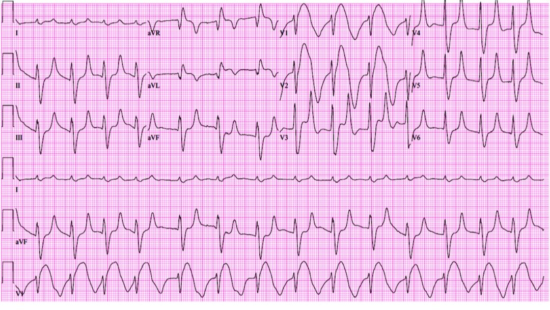 TrackYourHeart's tweet photo. A 34 y/o woman presented with diabetic ketoacidosis, metabolic acidosis, and acute renal failure.
What's the most likely diagnosis ⁉️ https://t.co/1eOs8J0SHy