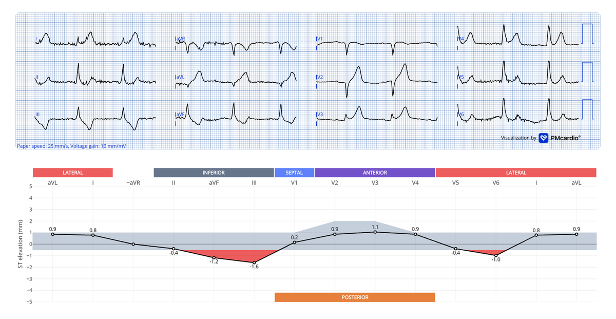 RobertHermanMD's tweet photo. Does this "NSTEMI" with an out-of-hospital cardiac arrest need immediate cath lab activation, or should we follow the guidelines?

Let me know what you think of this #ECG of a 50yo male patient with chest pressure and left arm numbness post ROSC! https://t.co/VUjhzUgHoF