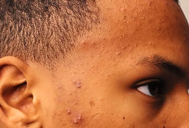 RoseOnX9's tweet photo. SIGNS OF EXCESSIVE TESTOSTERONE IN MEN:

Most men think more testosterone is always better.
Reality is more complicated.

1. Persistent Acne https://t.co/y52i4Ma1ix