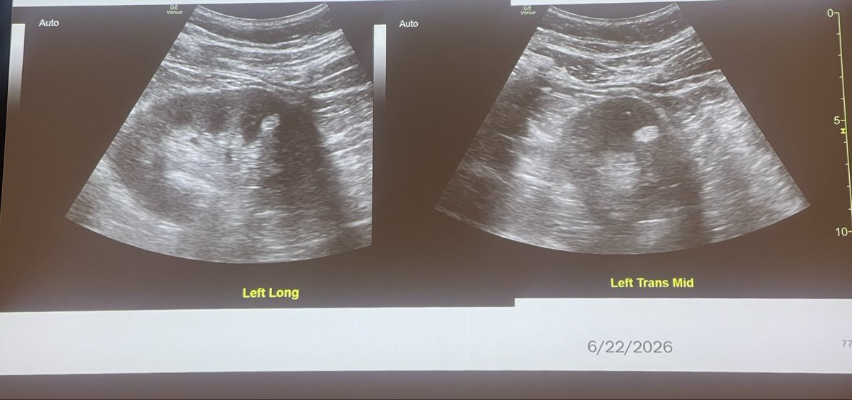 S0NOSCOPE's tweet photo. And keeping w common finding, “a discrete usually round, hyperechoic (bright) structure which does NOT have posterior enhancement , is a AML = Angiomoylipoma &amp; entirely benign @@RaphyRosen @brian_rifkin @NMawlaMD @PracticalPOCUS @POCUSJournal @pocus101 @RaphyRosen https://t.co/mf1Vhwdgeq