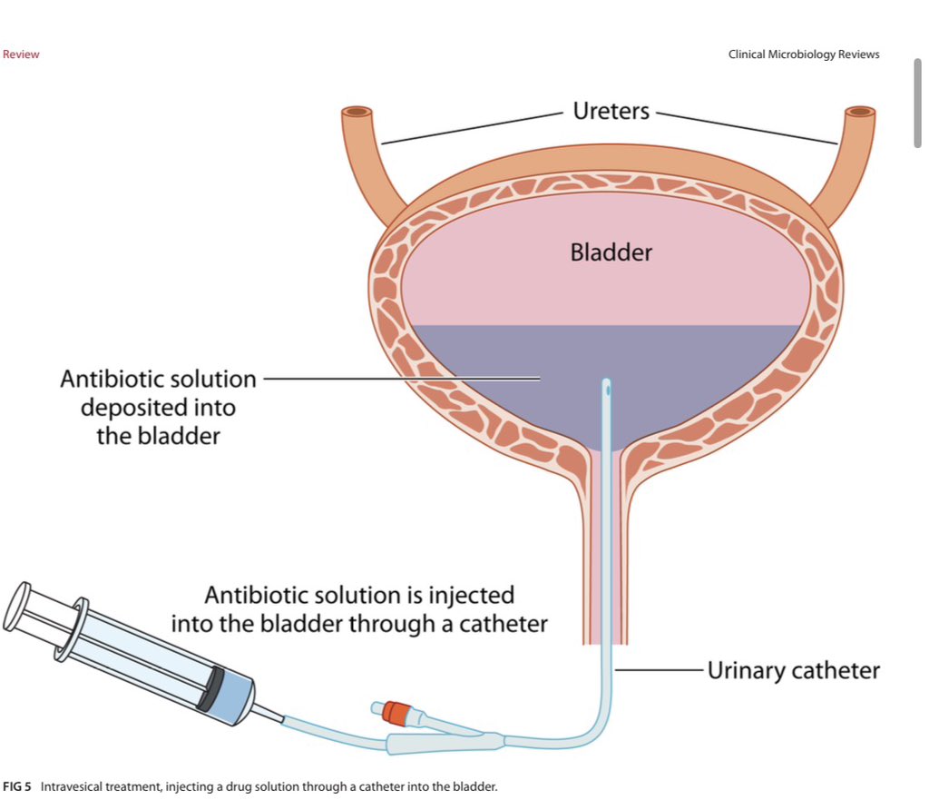 AliSMV7's tweet photo. Intravesical therapies for catheter-associated urinary tract infections: current approaches and future directions   

https://t.co/6Z1jQ2ZkwO https://t.co/EdyDn1T8wc