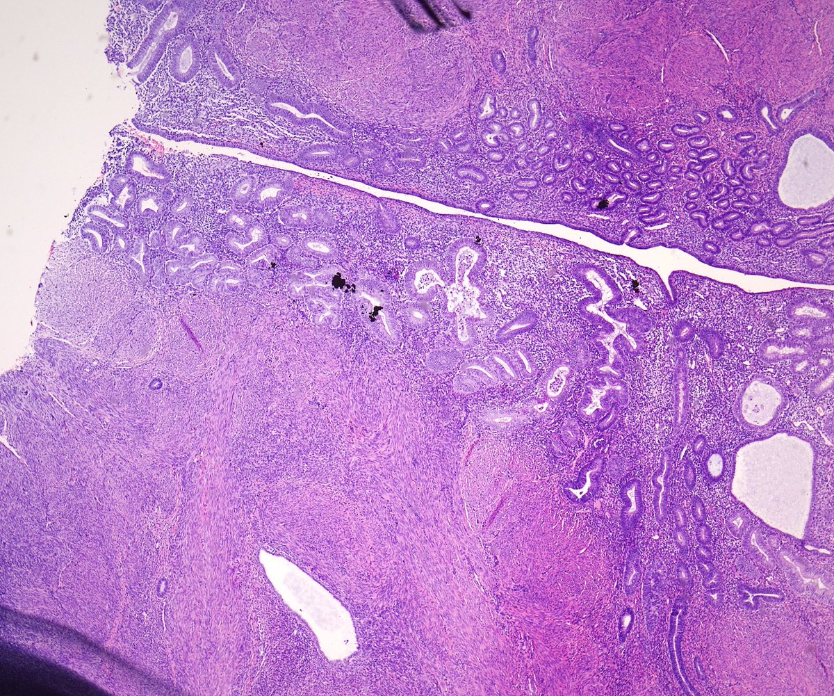 MirunaPopescu13's tweet photo. #Gynpath quiz 🧩
A 60ish female presents with postmenopausal bleeding and undergoes a total abdominal hysterectomy with bilateral salpingo-oophorectomy. This is the endometrium. What is the diagnosis?🔬
Next question in the 🧵👇🏼
#PathTwitter https://t.co/4UvGY3DThU