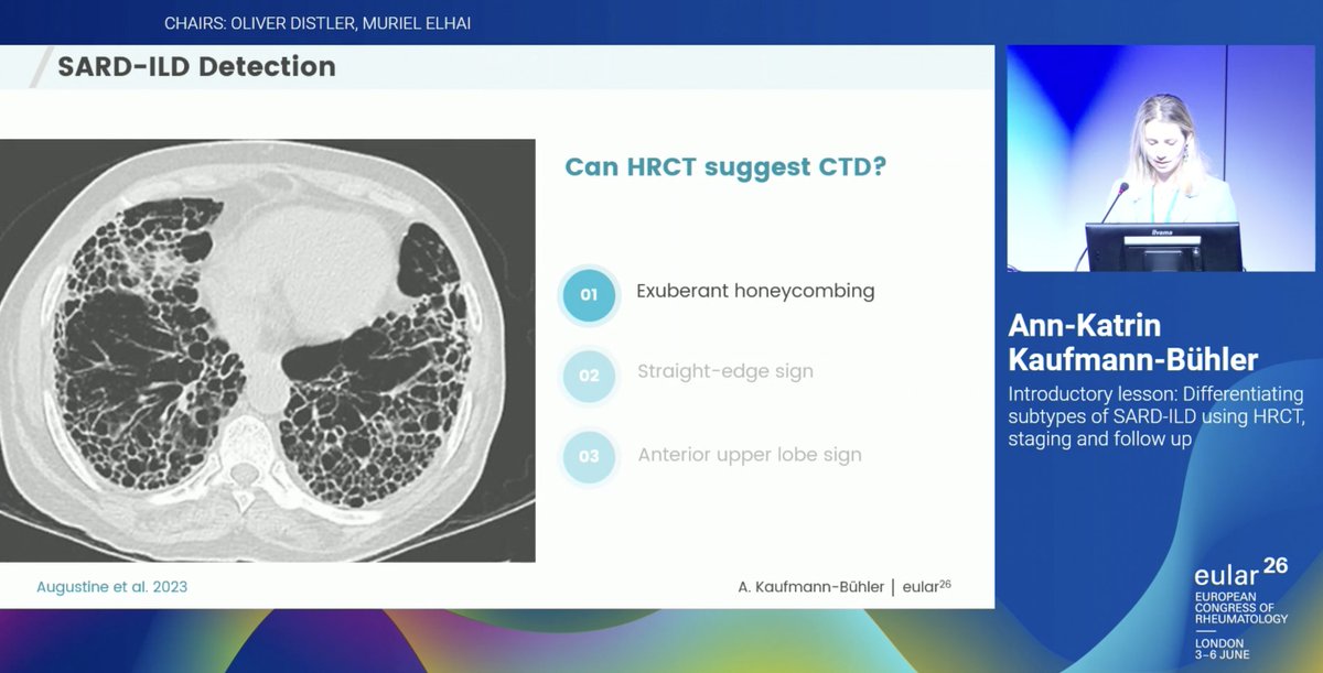 debaditya_roy's tweet photo. 💡Key HRCT clues suggesting #CTDILD highlighted at #EULAR2026:
🔹 Anterior Upper Lobe Sign
🔹 Exuberant Honeycombing
🔹 Straight Edge Sign
🔹 Four Corners Sign
💡Also look out for extrapulmonary clues! https://t.co/OCSDoK0q8P