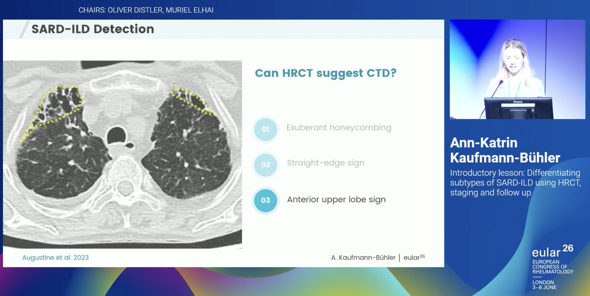 debaditya_roy's tweet photo. 💡Key HRCT clues suggesting #CTDILD highlighted at #EULAR2026:
🔹 Anterior Upper Lobe Sign
🔹 Exuberant Honeycombing
🔹 Straight Edge Sign
🔹 Four Corners Sign
💡Also look out for extrapulmonary clues! https://t.co/OCSDoK0q8P