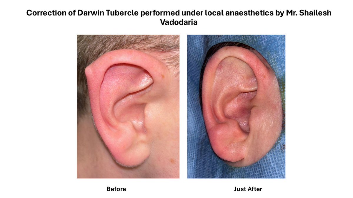 MedicalArtsCS's tweet photo. ✨ **Correction of Darwin's Tubercle Under Local Anaesthetics** ✨

This patient underwent **correction of Darwin's Tubercle** under **local anaesthetics** as a day-case procedure by **Mr Shailesh Vadodaria** at **MACS Clinic**. https://t.co/2oRMQEDKTU