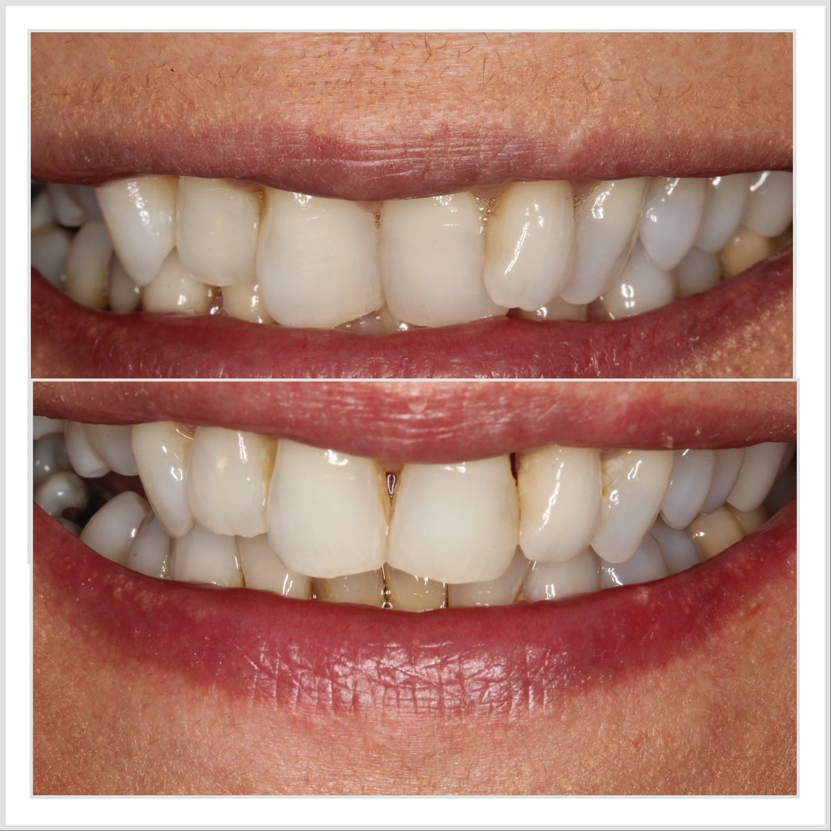 progresdent's tweet photo. Scorching case to start off a scorching week! Severe crowding corrected using a Social 6 lingual brace. Totally hidden, quick and affordable. Expertly done by Dr Nissit Patel https://t.co/a8k8eP5GER