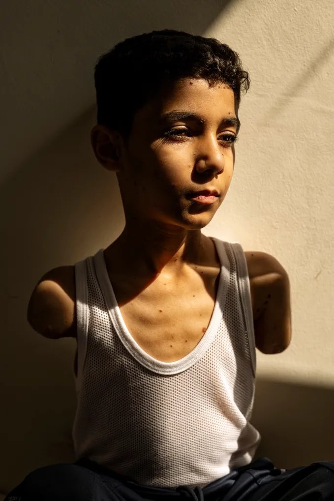 SebDFM's tweet photo. @BernieSanders Mahmoud Ajjour, nine years old and wounded during an Israeli attack on Gaza City in March 2024, finds refuge and medical care in Doha, Qatar, on June 28, 2024. Winner of the 2025 World Press Photo of the Year award. 📷 Samar Abu Elouf/The New York Times/World Press Photo https://t.co/VUiqr7UAYz