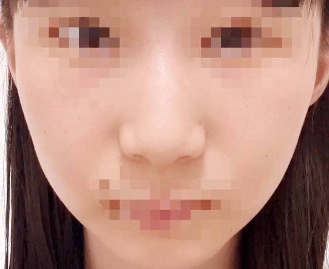 e_mrsa's tweet photo. FINT美容外科で鼻フルを行ってから1週間が経ちました🖤プロテーゼは使用せず、自家肋軟骨で行いました✨まだ腫れはありますが綺麗な鼻になり、とても嬉しいです！

←Before                                       after→ https://t.co/IB78ZJhvIu