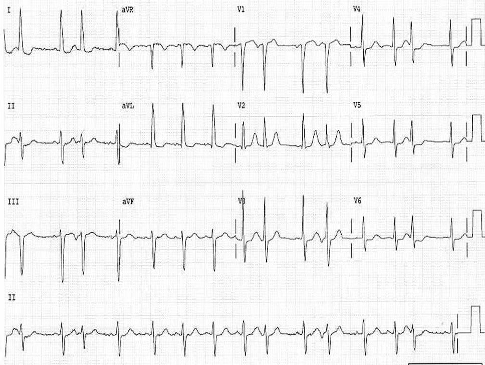 PPodrid's tweet photo. Patient complains of palpitations. What does the ECGs show?  #PodridECGs #ECG #meded #cardiotwitter https://t.co/l8Afe1B1in