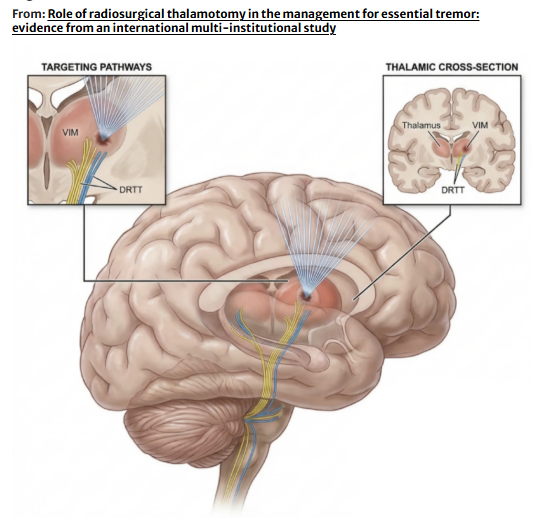 jasonpsheehan's tweet photo. A new international, multicenter study on functional radiosurgery for essential tremor in Journal of Neurology.  Delighted to be a part of this study. https://t.co/L9k2Omc2rY