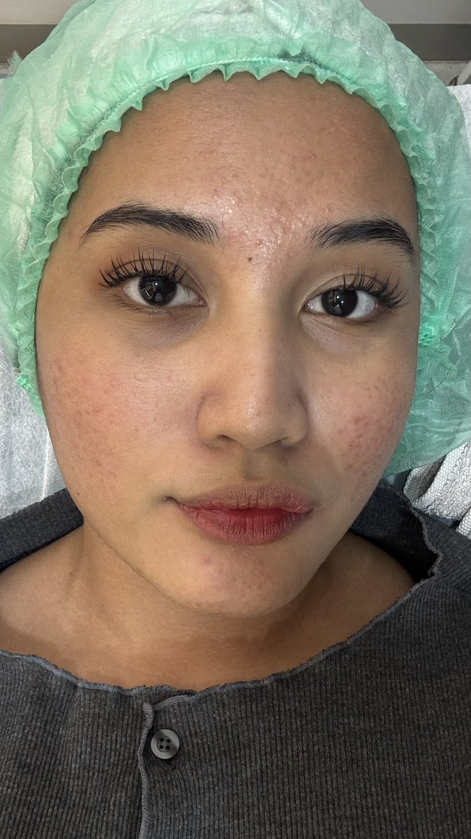 lioness33's tweet photo. Muka aku, sebelum tau how to mengendalikan hormon n belajar obat topikal yg good for skin. https://t.co/MHwuTwkHqb