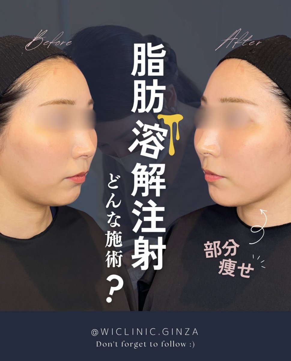 wiclinicpr's tweet photo. ＼気になる部分脂肪に💎／

脂肪溶解注射は
フェイスラインやあご下など
気になる脂肪へアプローチ✨

部分痩せしたい方にも
おすすめの施術です🫧

詳しくは画像をチェック🌿
7月キャンペーン実施中です🌻

#ウィクリニック #ウィクリニック銀座院
#脂肪溶解注射 #FatXCORE #部分痩せ #美容医療 https://t.co/ytxZyLaUvw