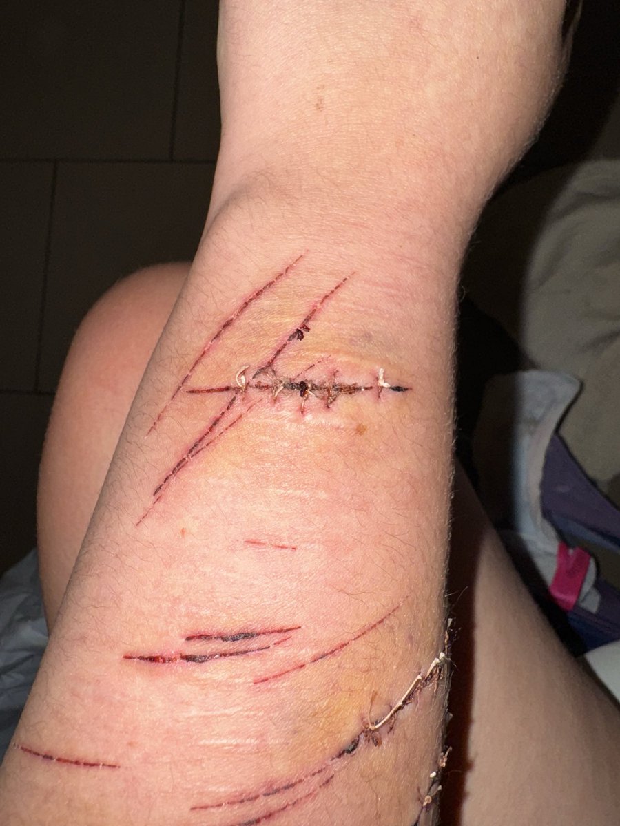 MischievousL0k1's tweet photo. Got picked up by cops and landed in hospital lol, had to get stitches the lidocaine bruised horribly. 
TW: Stitches and Bruises #shedtwt #shtwt https://t.co/zhExewEnWy