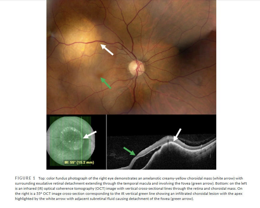 HeadacheJournal's tweet photo. Open Access:
New #headache + vision loss isn't always #migraine

This case report follows a patient whose eye symptoms were traced to lung #adenocarcinoma metastasis 

🔍Funduscopic examination can be diagnosis-changing
🔗https://t.co/28b2NiLsKc
@laurel_tanke @NCherayil et al https://t.co/n5zcMnd4Se