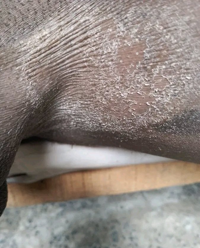 RudeBwoy_254's tweet photo. What causes this condition, and how can it be treated or cured? 💔😭 https://t.co/9RWrpkyvFB