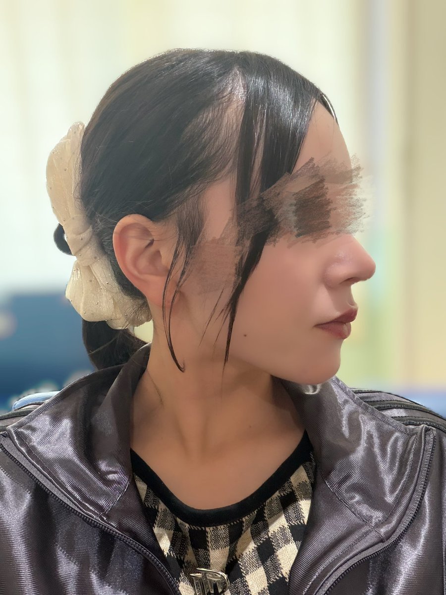 33333pyo's tweet photo. 【DU美容外科さん】
今回お願いする施術は🥺🥺

DUシルエット輪郭術2段階
首の筋肉下脂肪吸引
バッカルファット除去
エラボトックス
脂肪移植（ほうれい線）
糸リフティング 
チークリフティング
@dups_jp
��前レポ 😌😌 https://t.co/ykuMhOPF9j