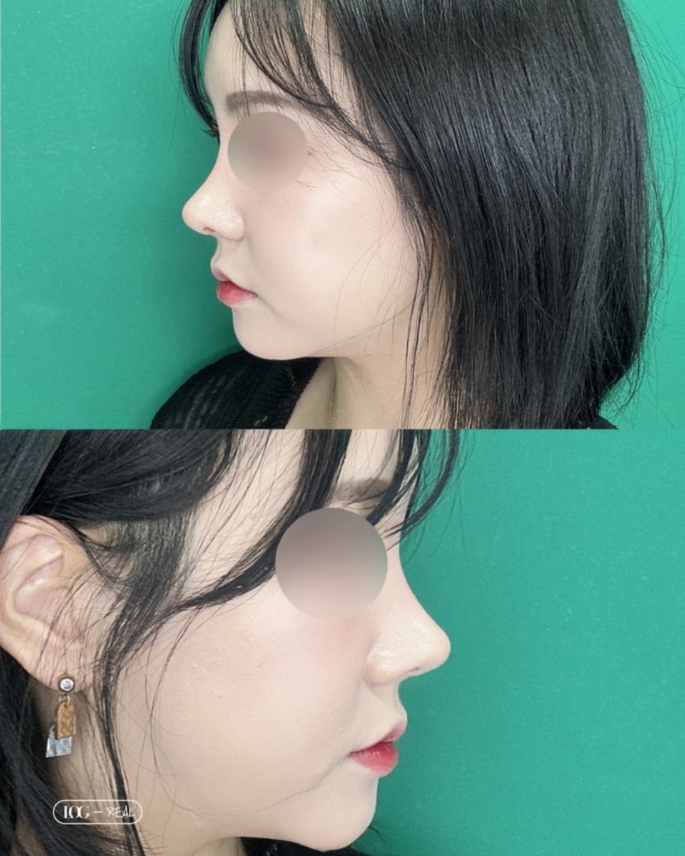 Logps_jp's tweet photo. 可愛すぎる鼻ライン👃✨

女性らしさがぐっと引き立つ仕上がりです💖

LINE🦌@log-jp

🏥ログ美容外科
新論峴駅(シンノンヒョン) 7番出口から徒歩3分

🕒営業時間
*月〜金曜 10:00~19:00
*土曜 10:00~17:00
*日曜 定休日（毎週日曜）

#韓国整形 #鼻整形 #渡韓整形 https://t.co/VMuuqJijxS