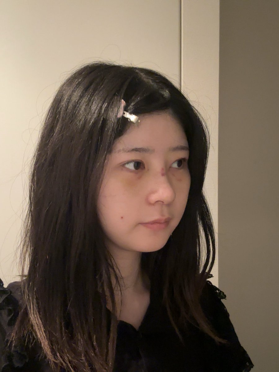 aaxwko's tweet photo. シュガー美容外科で目 鼻の施術 抜糸をしてきました！🇰🇷✈️
執刀医はキムジンヒョン院長先生です

写真は術後1週間たち、抜糸後日本に帰国した後の写真です

目も鼻もとてもナチュラルに仕上げていただきました( т т )💧
また経過載せていきます

#シュガー美容外科 #鼻整形 #韓国 #キムジンヒョン院長 https://t.co/3nYV2D2rHe