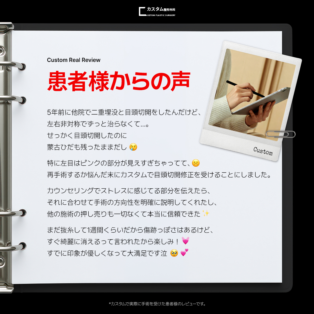 customps1's tweet photo. 他院での目頭切開後、左右非対称や蒙古ひだが残ってしまったこと、そしてピンクの部分の見えすぎにお悩みだった患者様のリアルレビューです😢🖤

お写真は抜糸後1週間、DT7日目の状態です✨
まだ赤みや傷跡の硬さがある時期ですが、すでにきつかった印象が和らぎ、優しく自然な目元へと改善されているのがお分かりいただけるかと思います。

時間が経つにつれて、傷跡はさらに目立たなく馴染んでいきます。他院修正でお一人で悩まれている方も、ぜひ一度お気軽にご相談ください🕊️

#韓国整形 #目頭切開修正 #カスタム整形外科