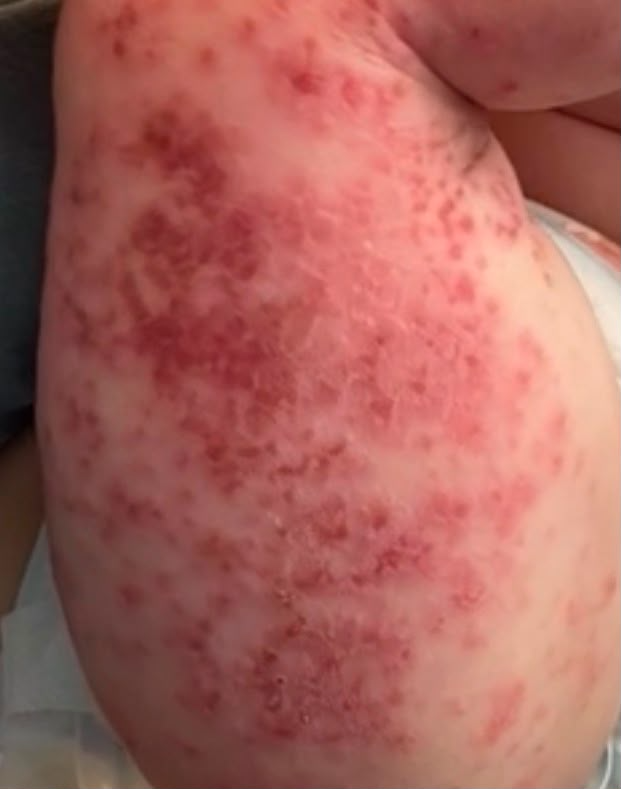 aderemi_haruna's tweet photo. I visited my sister after my exams, hoping to surprise her.

But I was shocked to see reddish marks on both of her son’s legs. 😟

Has anyone seen something like this before? What could it mean, and is it curable? https://t.co/oeNdvggUJG