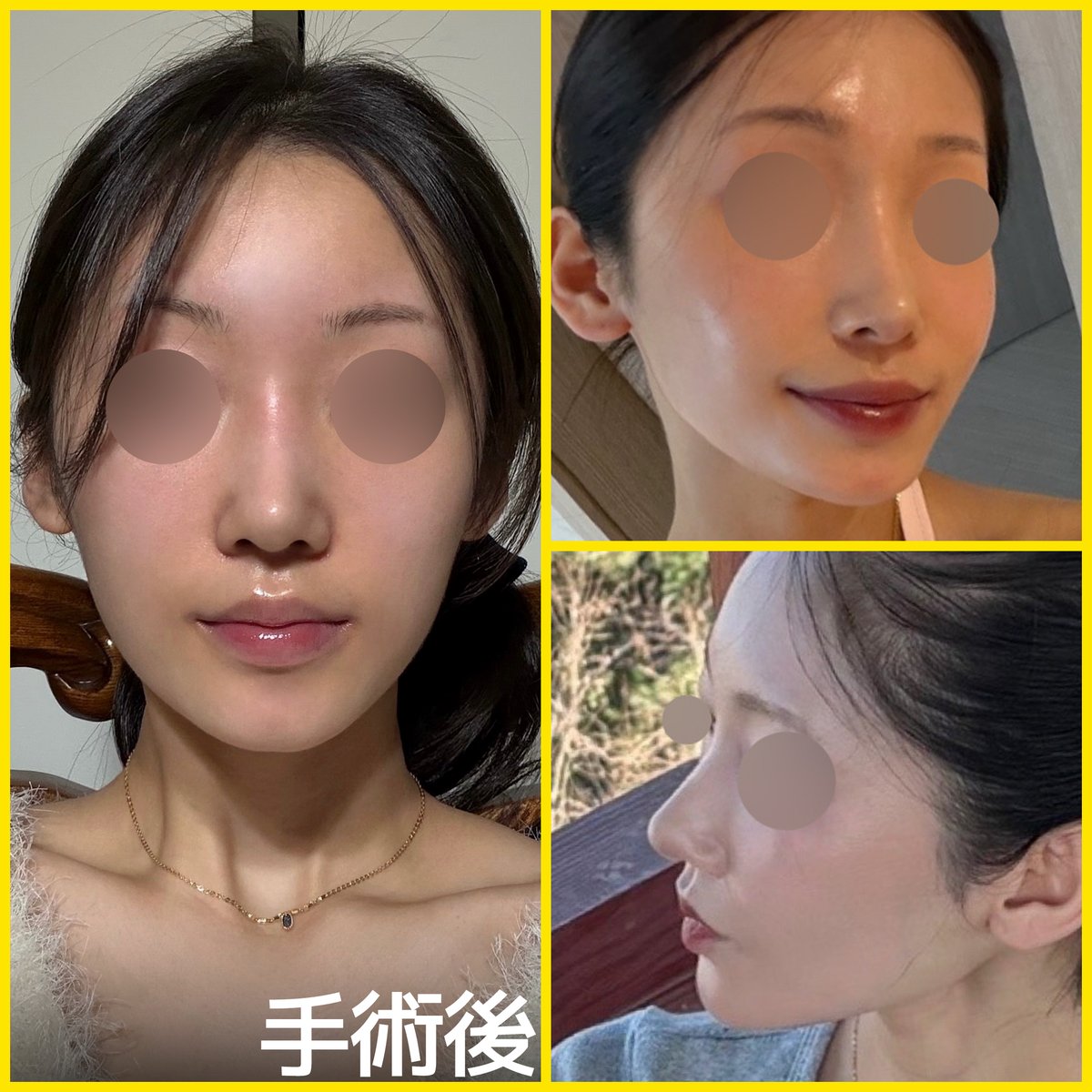 bananaps__'s tweet photo. バナナ美容整形外科 鼻手術 症例💛

鼻の手術後、より可愛らしい印象になりました🎀

・鼻筋は女性らしいラインに
・鼻先は尖りすぎない丸みのある仕上がり

#鼻 #鼻整形 #鼻手術 #鼻フル #鼻修正 #鼻DT #鼻フルDT #鼻フルレポ #整形情報 #整形レポ #整形垢 #整形垢さんと繋がりたい #ダウンタイム https://t.co/jfRF50474i