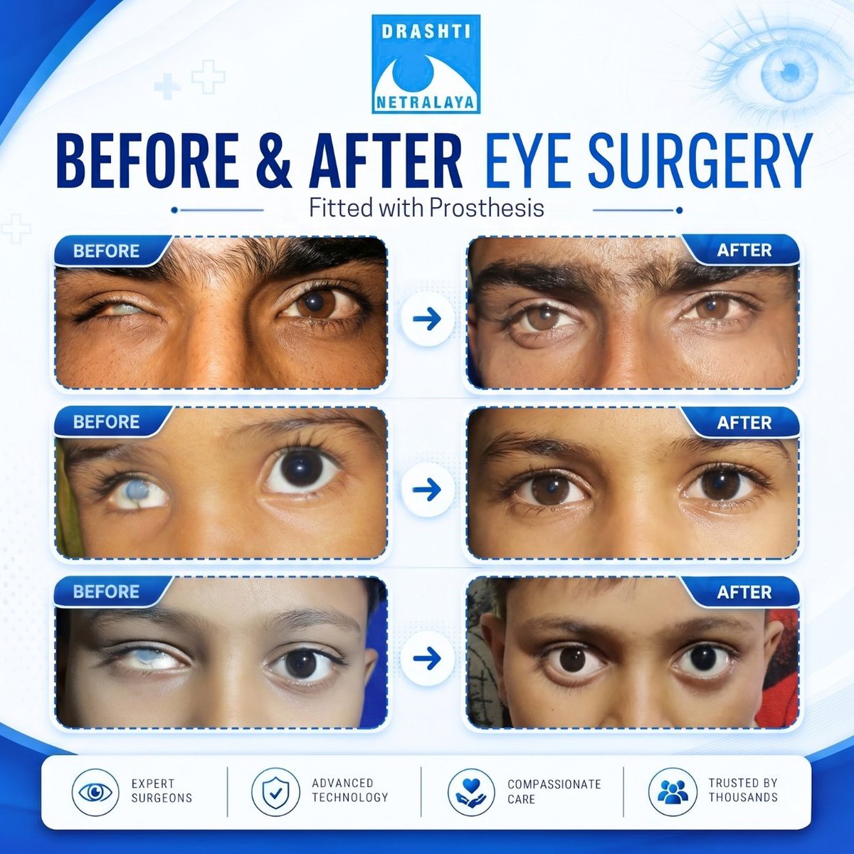 omtrust's tweet photo. Your vision deserves a second chance to embrace the faces you love, the bright colours of life, and the moments you cherish. At Drashti Netralaya, we strive to make that possible, giving your story a beautiful new lease of life.

#drashtinetralaya #eyesurgery #prosthesis https://t.co/M10Kvnxeq1
