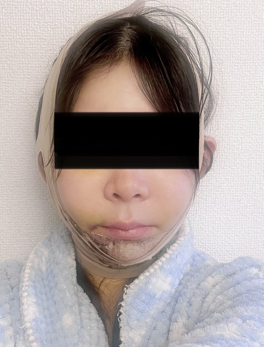 heart_minao's tweet photo. @CbkpsJ 【術後1週間目】
まだまだ腫れてるので少しでも早く腫れを引かせるためにフェイスバンド継続中…

両耳前と両エラ下？抜糸したけど全然痛くなかった。テープ剥がす時が1番痛い笑
乃木坂ACクリニックさんでやったけど初診代込み6,600円(変動あり)で安かったし女医さん優しかったよ〜

#ピン除去 https://t.co/9rEvcOHsq1