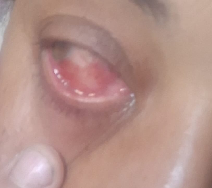 Moayad36638077's tweet photo. I've been suffering from eye pain for three days, and it's getting worse. I urgently need a medical check-up that costs $20, but I can't afford it. Any help or share would mean a lot. 🤍 https://t.co/iJskNqSYzz
