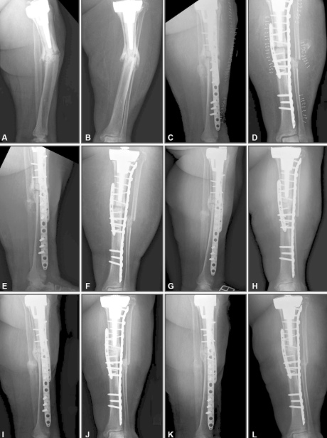 jbjs's tweet photo. "Biomimetic Hematoma Enables Healing in Complex Periprosthetic Fracture Nonunion with Multiple Comorbidities" by Maestas et al.
Read the full article π https://t.co/cv73LtCkVV
#JBJS https://t.co/RTQIj6DbQW