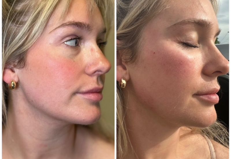 OpenDoorMedSpa_'s tweet photo. Derma Gel PRP is becoming one of the most sought-after regenerative treatments for individuals looking to refresh and restore their skin without invasive surgery.👉Click here to learn whether this treatment is right for you: https://t.co/aWg9Vqpcea https://t.co/YwJUGw4tYc