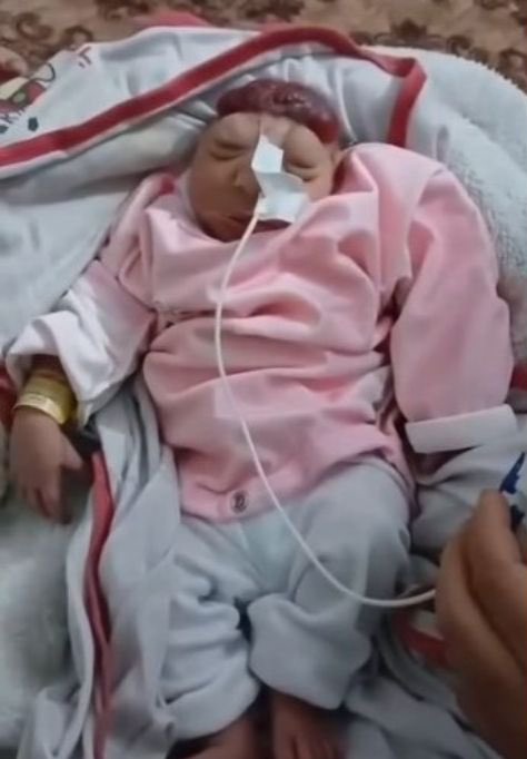 ruyaselcuk's tweet photo. Gazze Sağlık Bakanlığı: "Düşük vakalarında ciddi artış var, fetüslerde deformasyon vakaları giderek çoğalıyor."

Gazze’de bebekler ağır anomalilerle doğuyor: eksik uzuvlar, kafatası deformasyonları, kalp ve beyin bozuklukları. Bunun sebebi İsrail’in kullandığı zehirli silahlar.

#SeeHearSpeakPalestine #FreePalestine #GazaGenocide