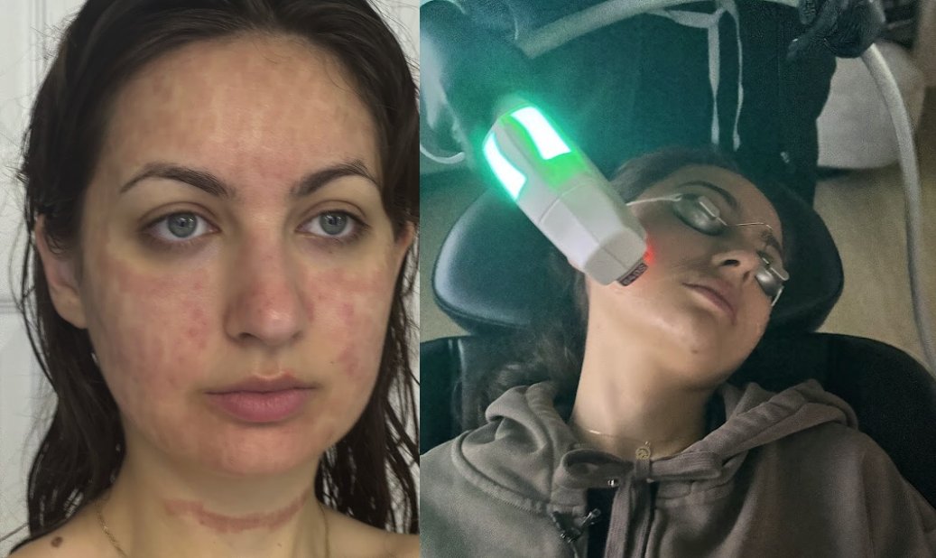 _katetolo's tweet photo. Below is everything I’ve done for my skin.

It includes both present and past:

+ Microdose of accutane
+ Hyaluronic acid supplement
+ Vitamin C supplement
+ Omega-3 supplement
+ Copper supplement
+ Vitamin D supplement
+ Other supplements listed below
+ Avoid sun UV rays
+ Better sleep
+ Better nutrition
+ Better exercise
+ BHA, beta hydroxy acid
+ Niacinamide
+ Azelic acid
+ Tretinoin
+ Red light therapy
+ Microneedling
+ IPL (BBL)
+ Sculptra
+ 1550nm
+ Sofwave
+ 595 nm pulsed dye laser

I also use these products below for skin health… they’re an important part of my protocol… so it would be weird not to mention them… but they’re also from our business, so just know that this is not me trying to sell you on them. You can get these things from us or somewhere else, I don’t mind.

+ Collagen
+ Extra Virgin Olive Oil
+ Longevity Mix
+ Omega-3
+ Advanced antioxidants
+ Essential capsules
+ Serum
+ Moisturizer
+ Cleanser

I achieved these results without botox and filler. You can too. Since getting these results, I’ve dabbled with botox & filler for facial balancing. Which is a whole other art form. I’ll do another post on those results later.