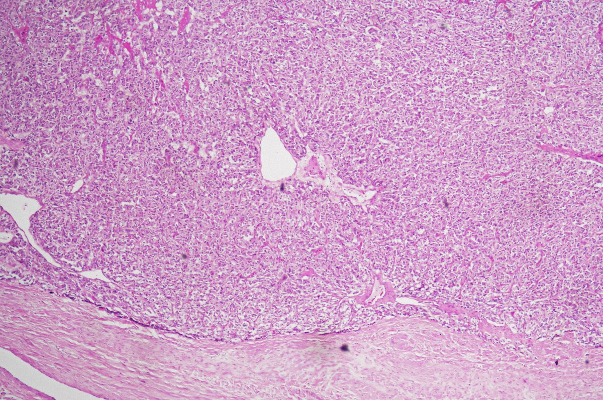 GuannanTiffany's tweet photo. 🧩 Bladder riddle

A nested lesion in the bladder. 🤔

Does every nested proliferation in the bladder have to be urothelial carcinoma?

What is your diagnosis?

#DxMindMap #BladderPath #GUPath #PathTwitter #Mimicker @JHUpath