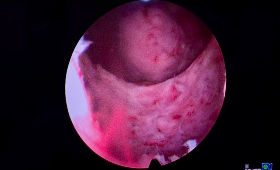 drglezb's tweet photo. People often see the surgery. They rarely see the journey behind it.
They see a surgeon performing a complex procedure and assume expertise..
#HOLEP #Urology #ProstateSurgery @MSGONZALEZURO @urotelio @Lara__Rodriguez #Innovation #Leadership #LearningCurve @todos @RomanCarvajal https://t.co/kXUUHnxy5d