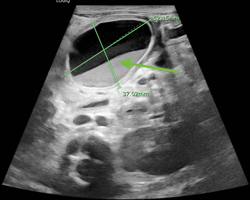 JPGNReports's tweet photo. Bryan &amp; Leibowitz: infant with FTT + hematemesis → gastrin 1700  👀

Hidden culprit? Gastric duplication cyst missed on initial imaging 🤯
Resection cured it.

#PedsGI #GITwitter #Endoscopy #Ulcer

🔗 https://t.co/2bXCSoUT52 https://t.co/1EkDtDsZVt