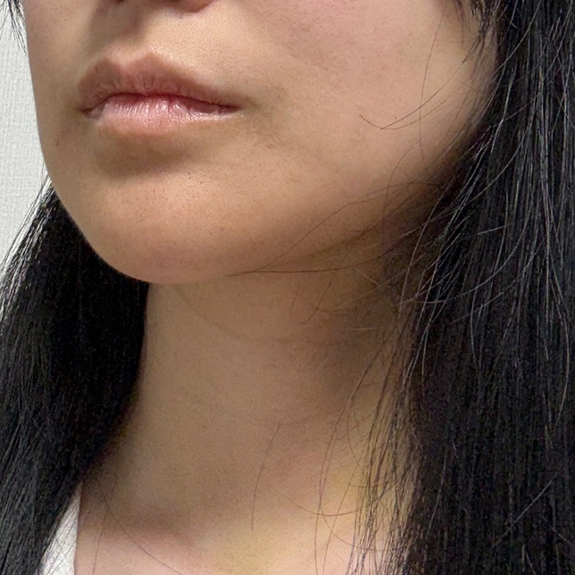 wooripsjp's tweet photo. 顎下のもたつきと二重あごがずっとコンプレックスで、体重を落としてもあまり変わらず悩んでいました😢
いろいろ調べてウリ美容外科で相談し、フェイスライン全体のバランスを見た施術を受けることに。

ダウンタイムはあったけど、徐々に顎下がすっきりして横顔も変化✨
今は写真も気にせず撮れるようになって満足しています🙂

#顎下脂肪吸引 #輪郭整形 #小顔 #美容整形 #脂肪吸引 #ビフォーアフター #フェイスライン #DoubleChin